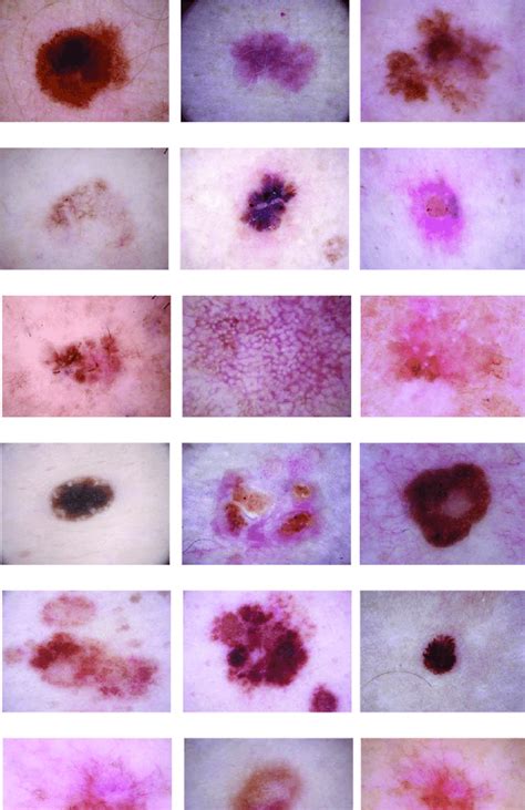 In vivo thickness measurement of basal cell carcinoma and actinic 